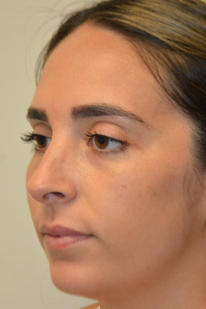 Rhinoplasty-10 | After Rhinoplasty 4