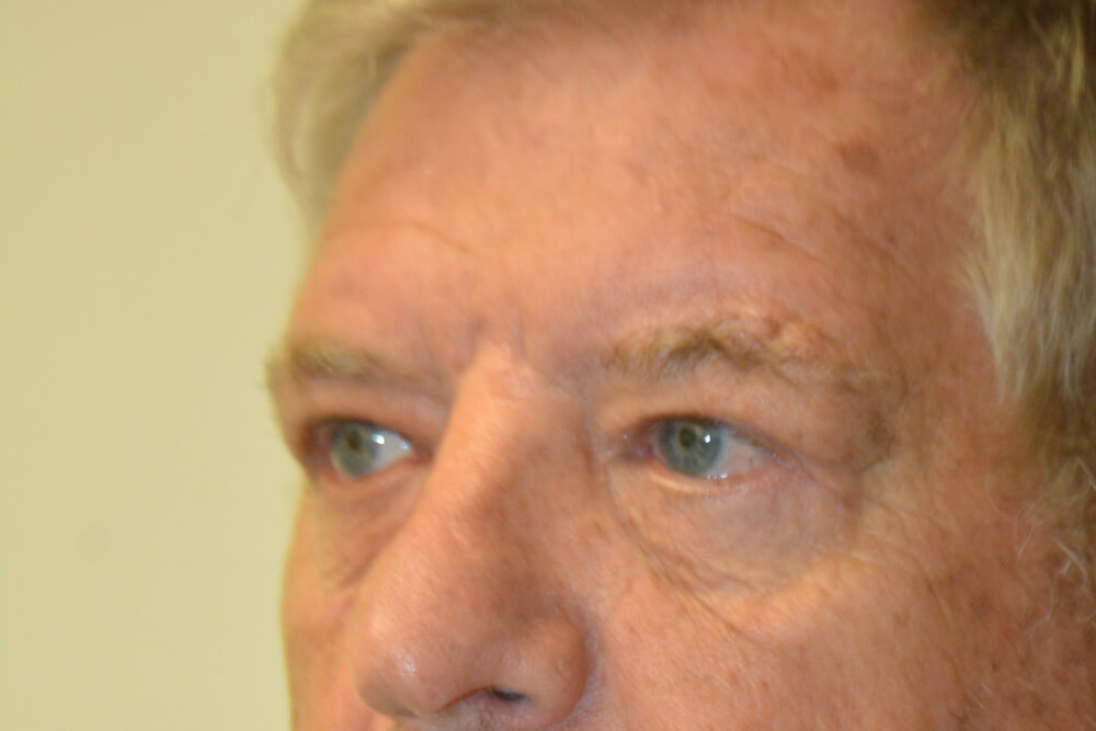 Eyelid-Surgery-01 | After Eyelid Surgery 2