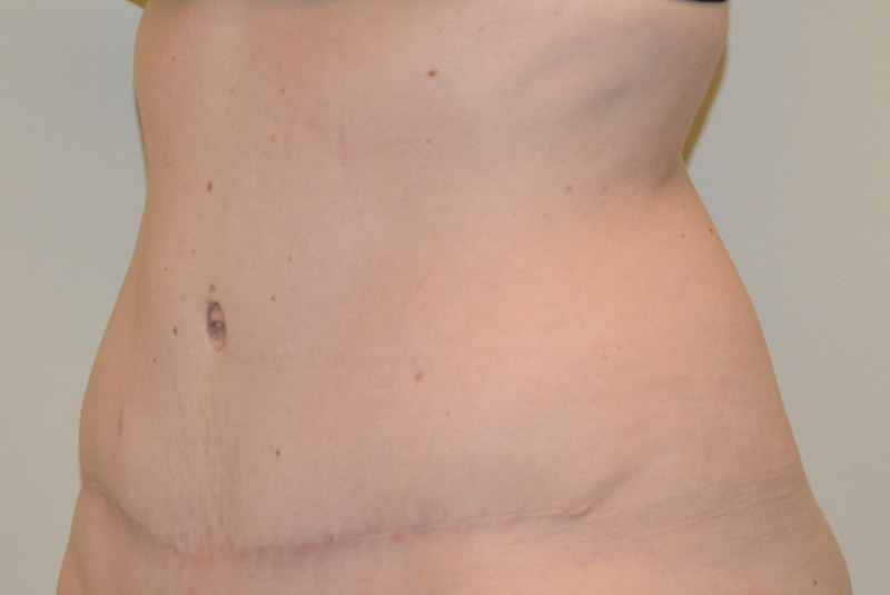 Tummy-Tuck-12 | After Tummy Tuck 4