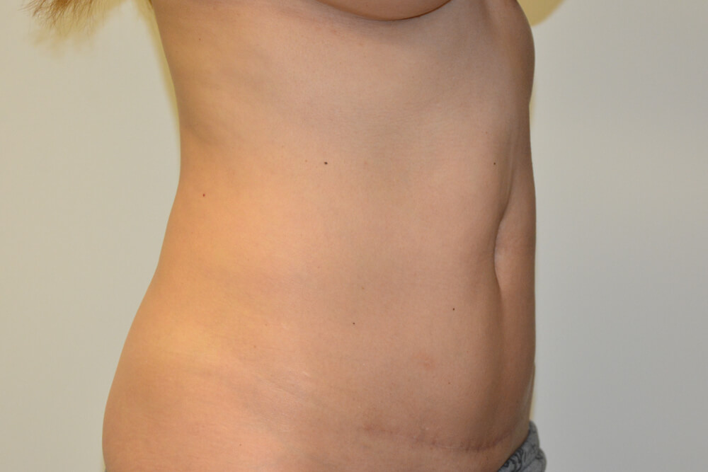 Mini-Tummy-Tuck-10 | After Mini Tummy Tuck 5