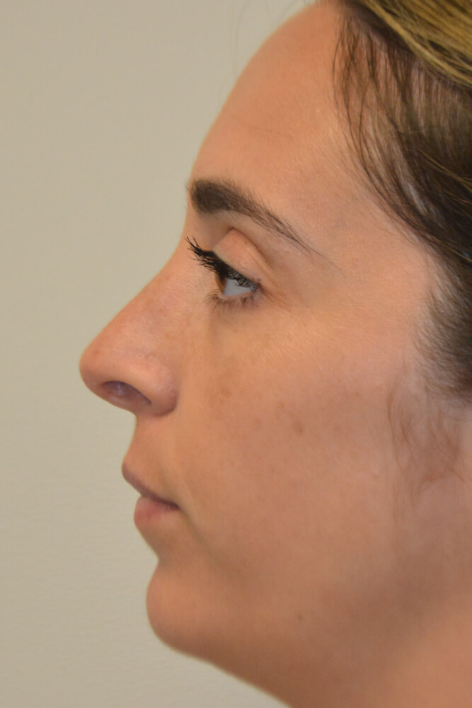 Rhinoplasty-10 | After Rhinoplasty 5
