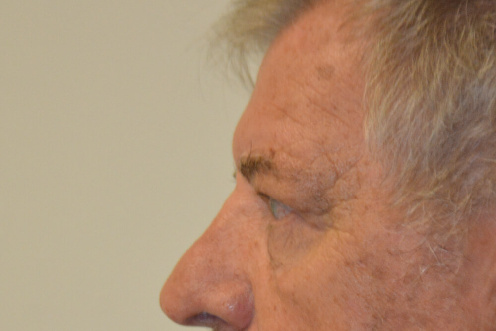 Eyelid-Surgery-01 | After Eyelid Surgery 3
