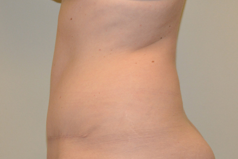 Tummy-Tuck-12 | After Tummy Tuck 5