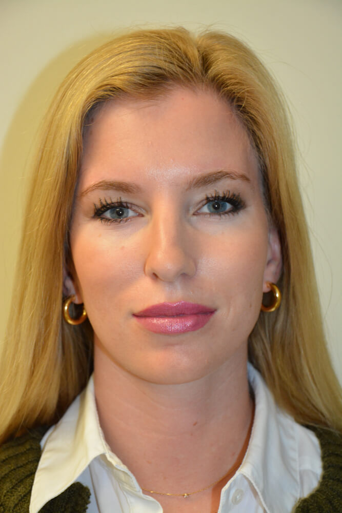 Rhinoplasty-11 | Before Rhinoplasty 5