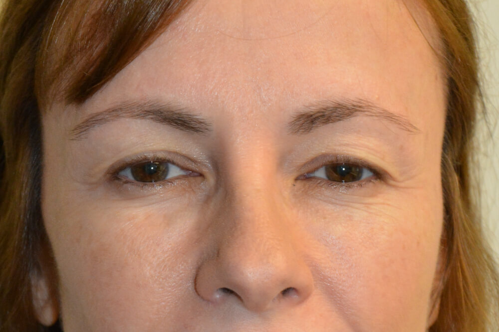 Eyelid-Surgery-11 | Before Eyelid Surgery