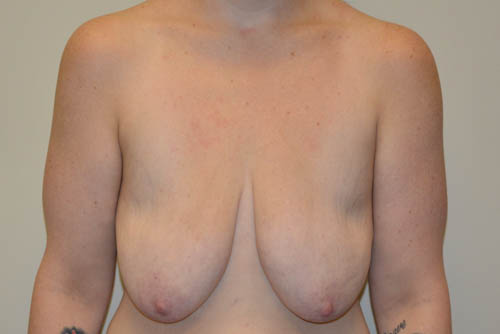 Breast-Lift-and-Augmentation-11 | Before Breast Lift and Augmentation