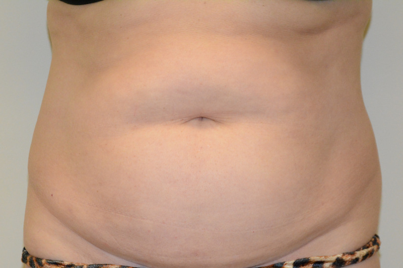 Tummy-Tuck-14 | Before Tummy Tuck