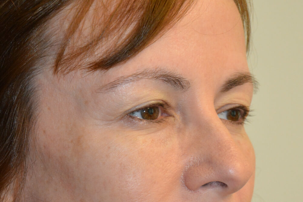 Eyelid-Surgery-11 | Before Eyelid Surgery 2
