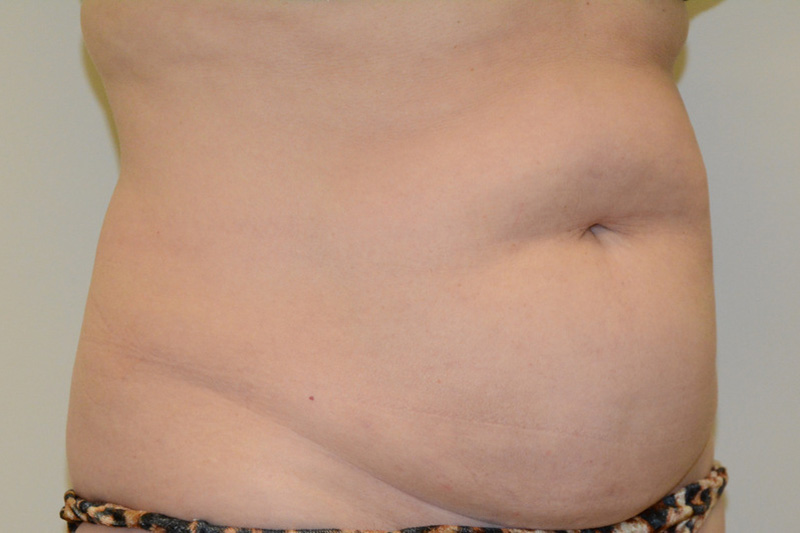 Tummy-Tuck-14 | Before Tummy Tuck 2