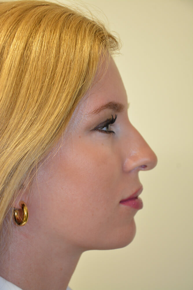Rhinoplasty-11 | Before Rhinoplasty