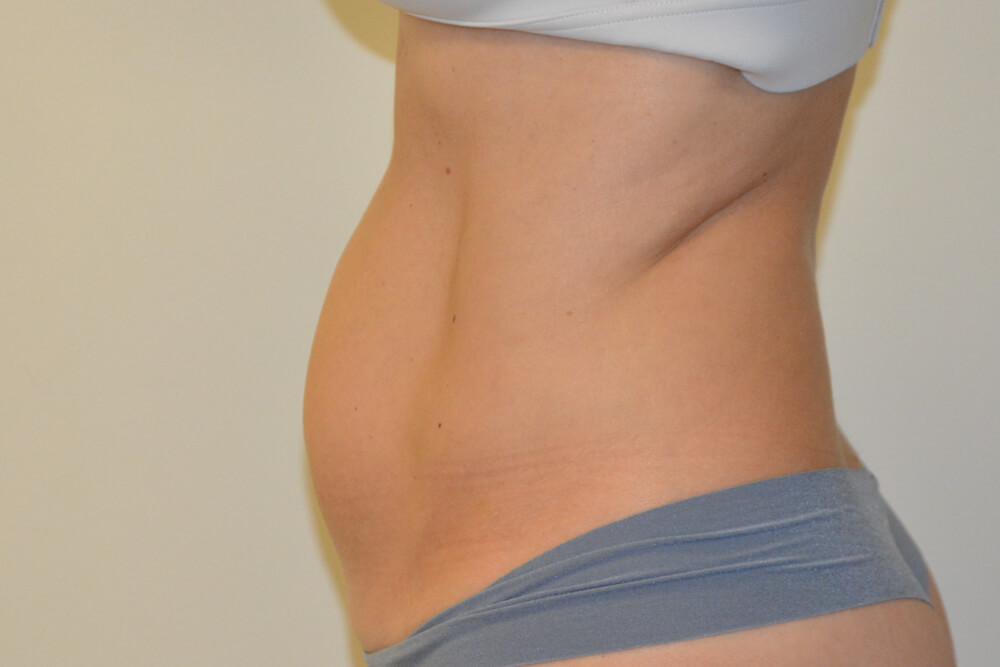 Liposuction-08 | Before Liposuction 3