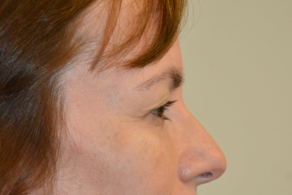 Eyelid-Surgery-11 | Before Eyelid Surgery 3