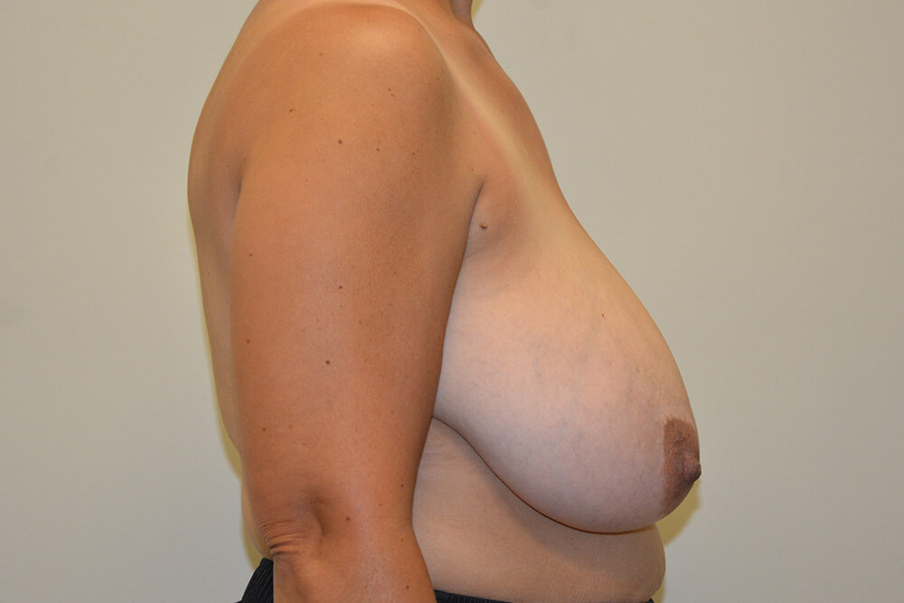 Breast-Reduction-11 | Before Breast Reduction 3