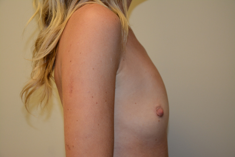 Breast-Augmentation-11 | Before Breast Augmentation 3