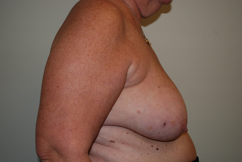 Breast-Reconstruction-Tissue-Expander-11 | Before Breast Reconstruction Tissue Expanders 3