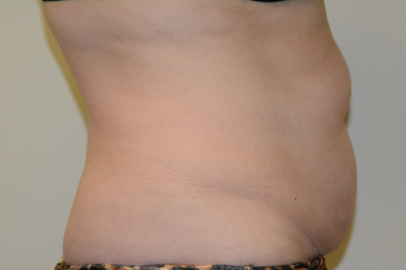 Tummy-Tuck-14 | Before Tummy Tuck 3