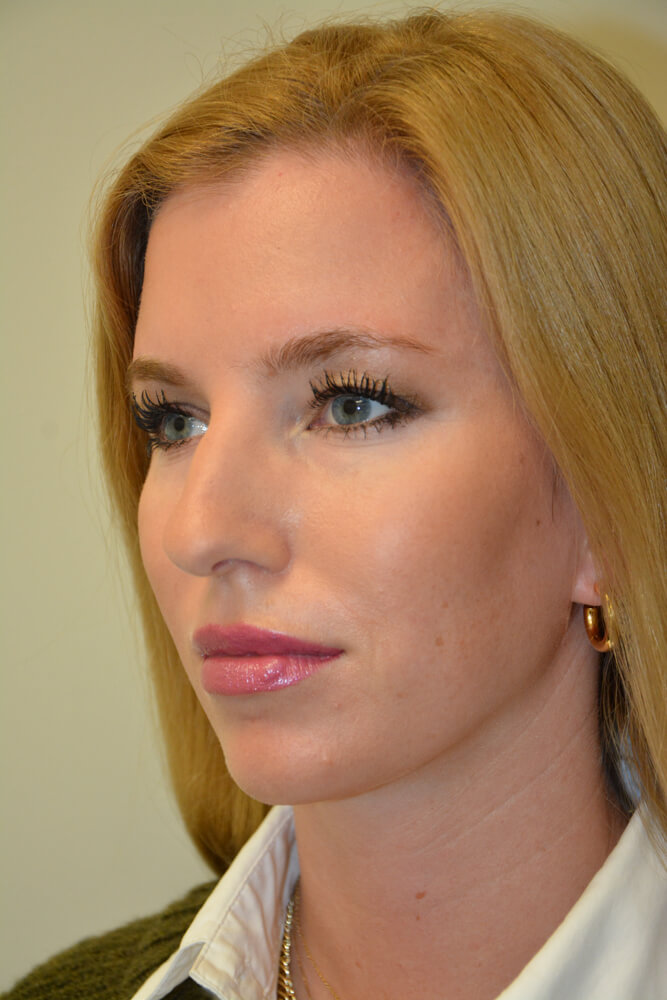 Rhinoplasty-11 | Before Rhinoplasty 4