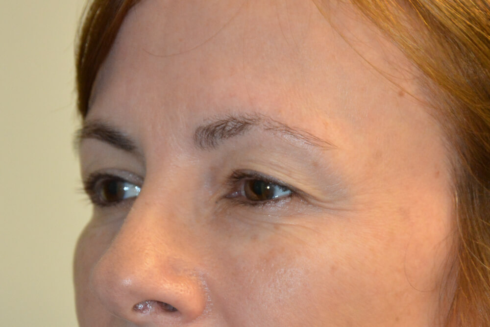 Eyelid-Surgery-11 | Before Eyelid Surgery 4