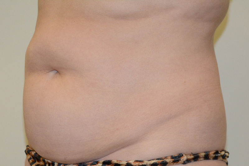 Tummy-Tuck-14 | Before Tummy Tuck 4