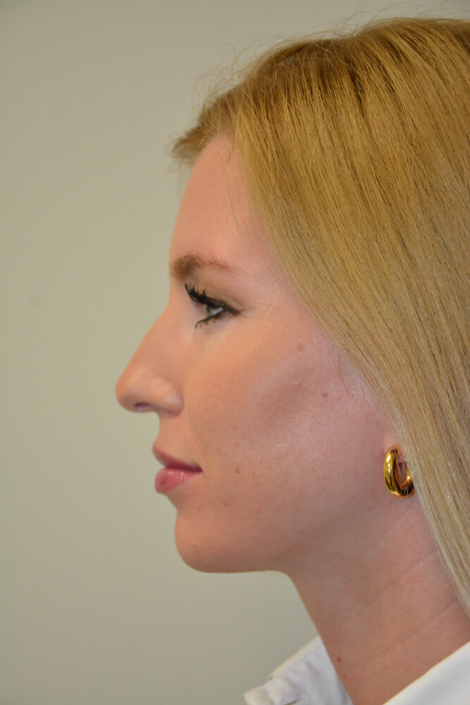 Rhinoplasty-11 | Before Rhinoplasty 3