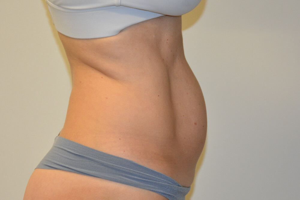 Liposuction-08 | Before Liposuction 5