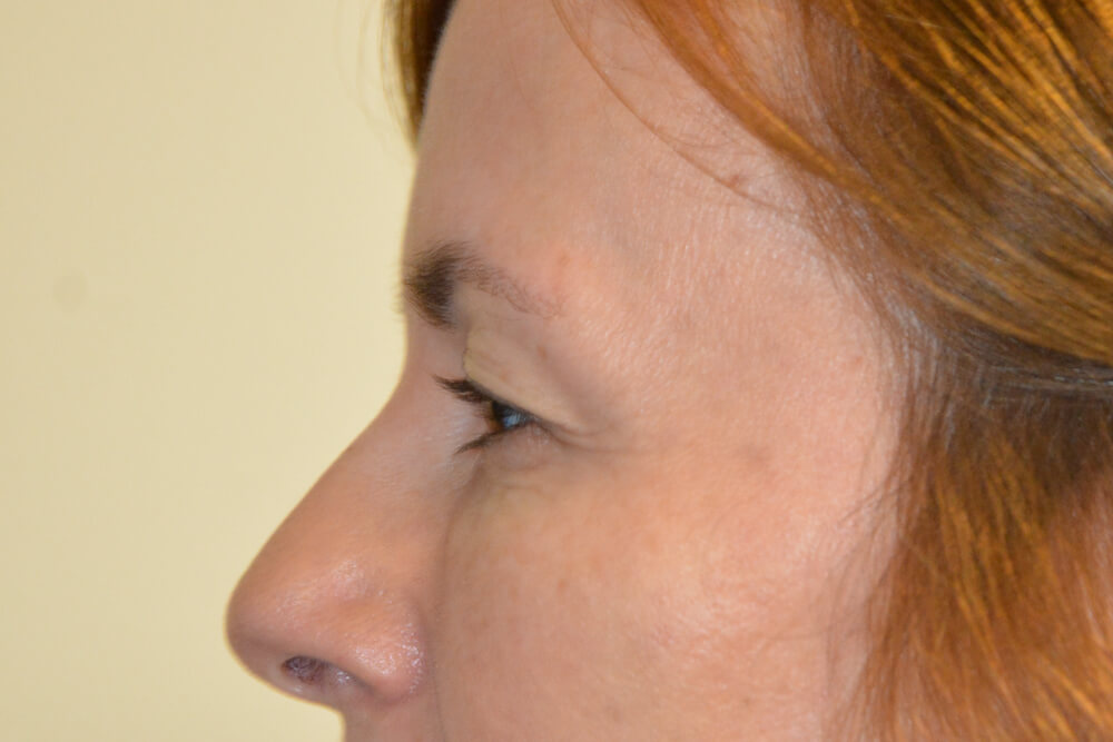 Eyelid-Surgery-11 | Before Eyelid Surgery 5
