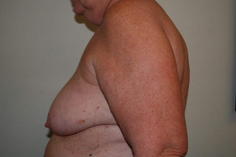 Breast-Reconstruction-Tissue-Expander-11 | Before Breast Reconstruction Tissue Expanders 5