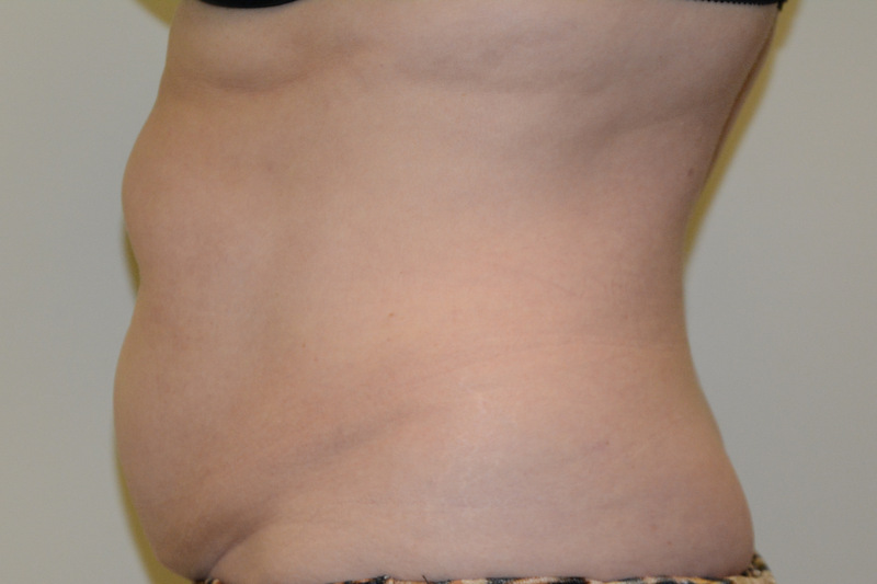Tummy-Tuck-14 | Before Tummy Tuck 5