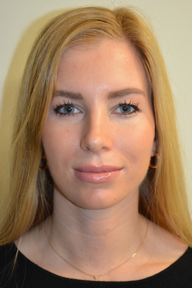 Rhinoplasty-11 | After Rhinoplasty 5