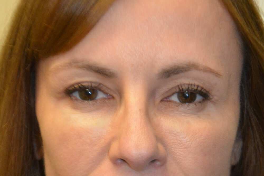 Eyelid-Surgery-11 | After Eyelid Surgery