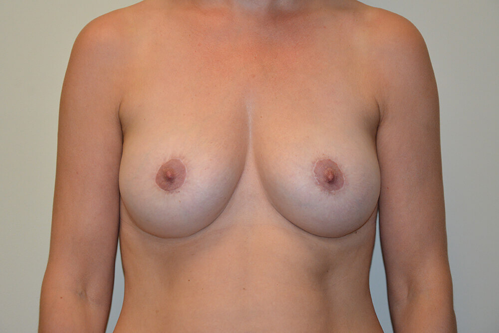 Breast-Revision-11 | After Breast Revision