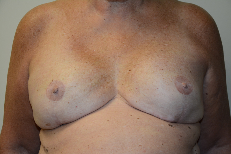 Breast-Reconstruction-Tissue-Expander-11 | After Breast Reconstruction Tissue Expanders