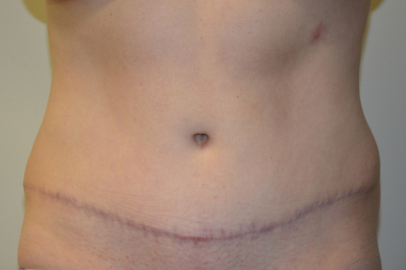 Tummy-Tuck-14 | After Tummy Tuck