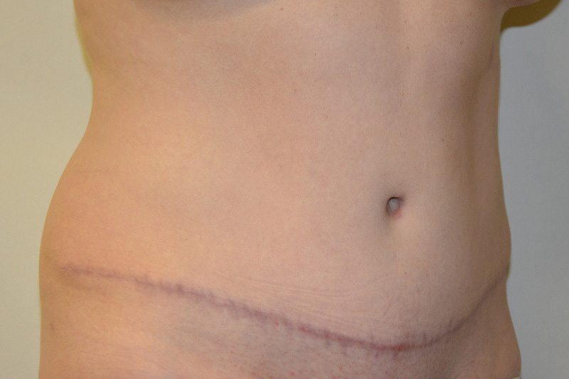 Tummy-Tuck-14 | After Tummy Tuck 2