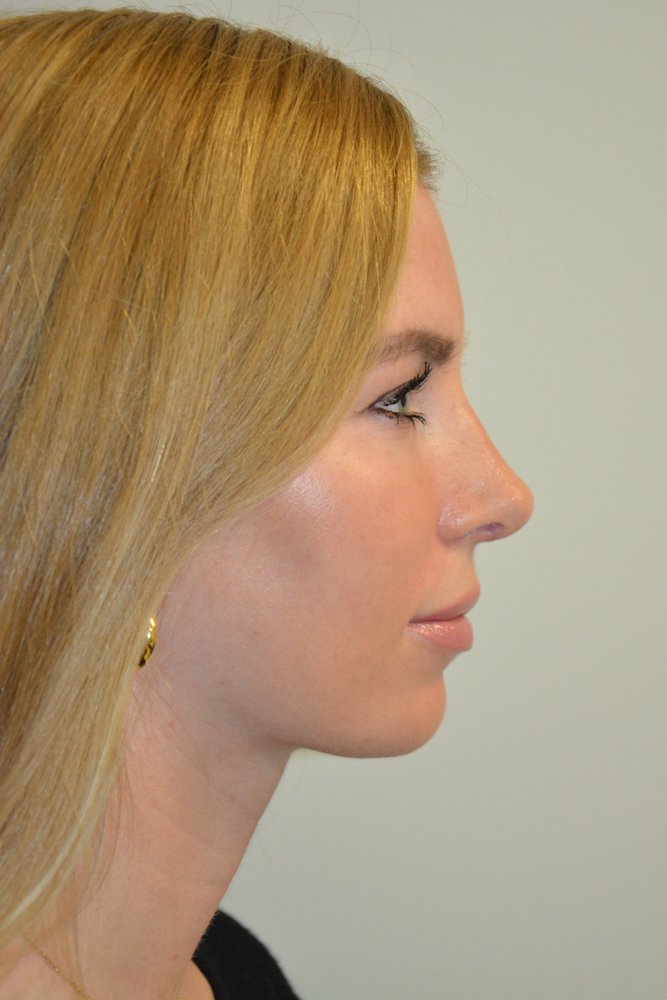 Rhinoplasty-11 | After Rhinoplasty