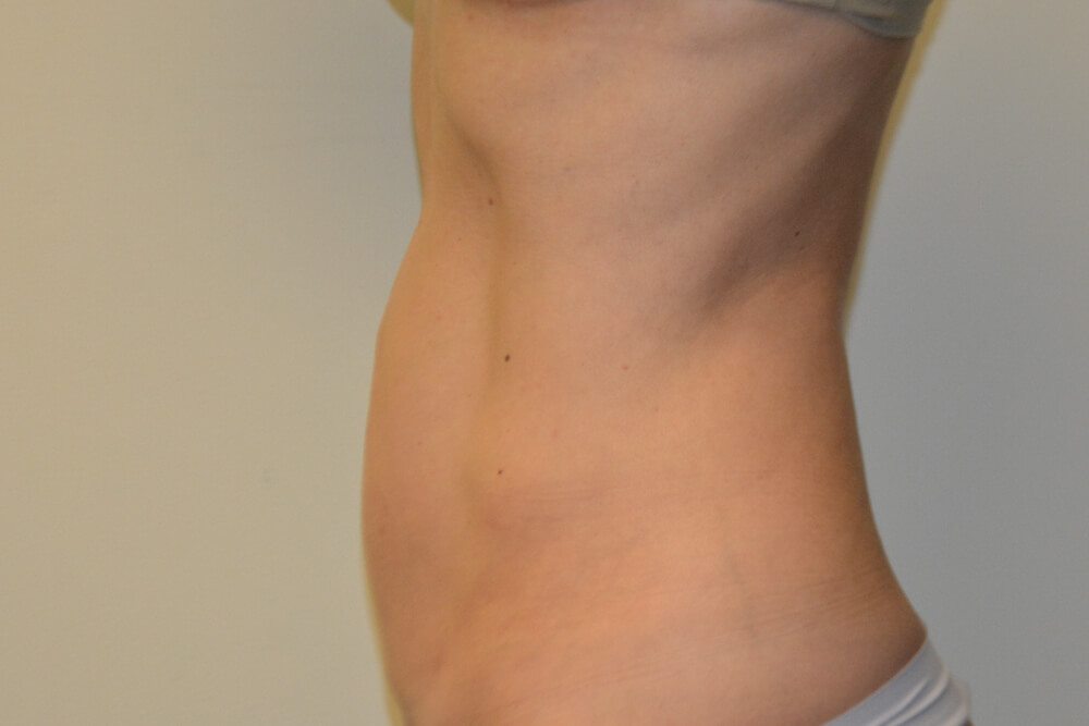 Liposuction-08 | After Liposuction 3