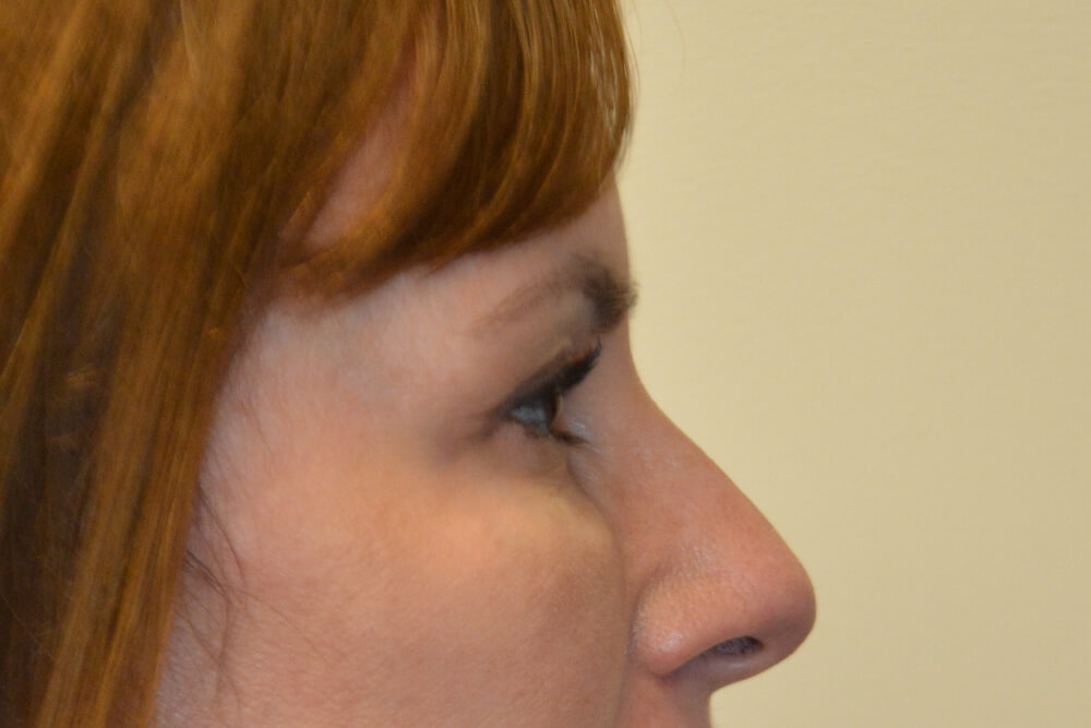 Eyelid-Surgery-11 | After Eyelid Surgery 3