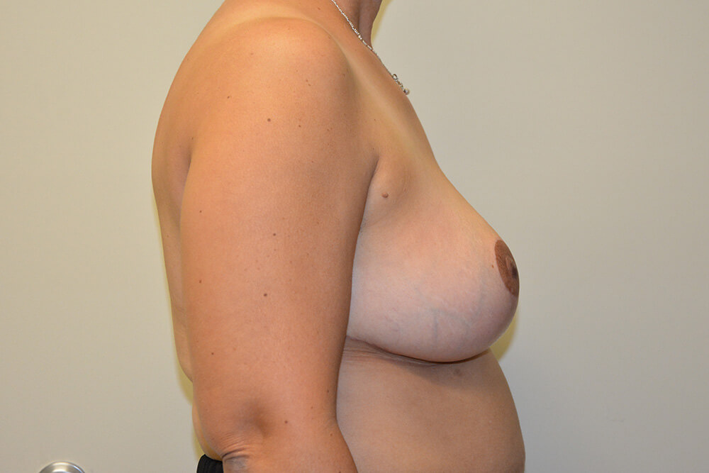 Breast-Reduction-11 | After Breast Reduction 3
