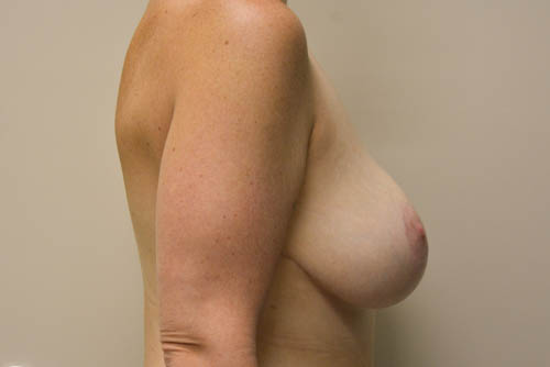 Breast-Lift-and-Augmentation-11 | After Breast Lift and Augmentation 3