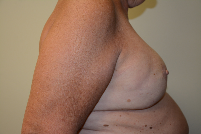 Breast-Reconstruction-Tissue-Expander-11 | After Breast Reconstruction Tissue Expanders 3