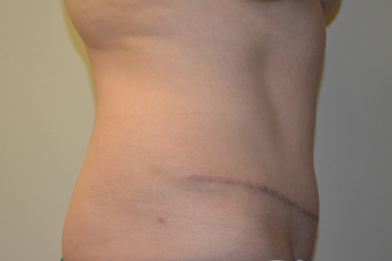 Tummy-Tuck-14 | After Tummy Tuck 3