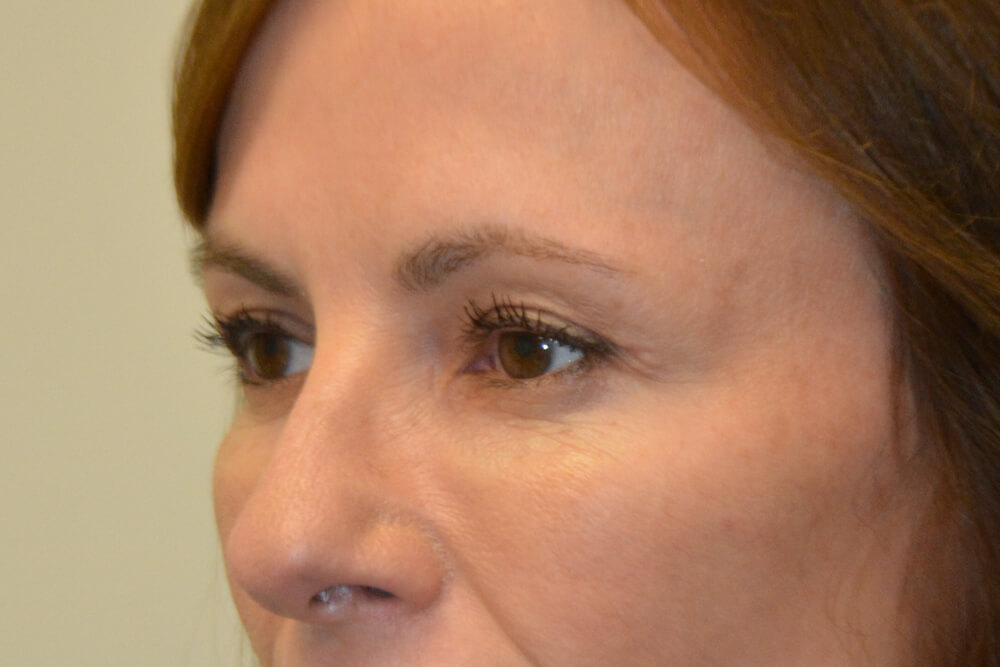 Eyelid-Surgery-11 | After Eyelid Surgery 4