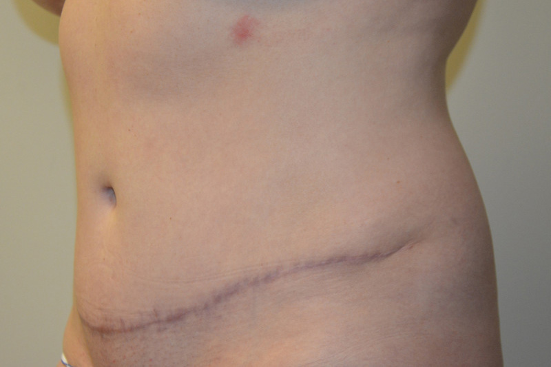 Tummy-Tuck-14 | After Tummy Tuck 4