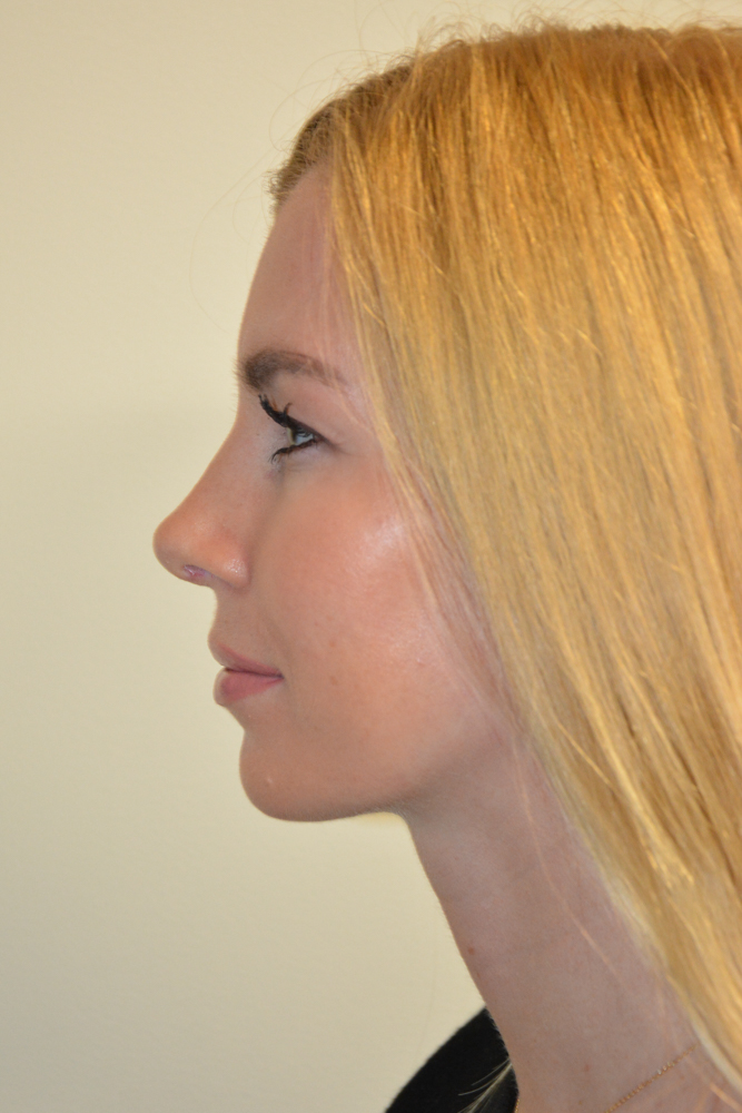 Rhinoplasty-11 | After Rhinoplasty 3