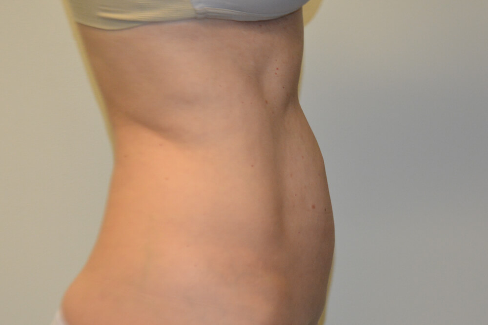 Liposuction-08 | After Liposuction 5