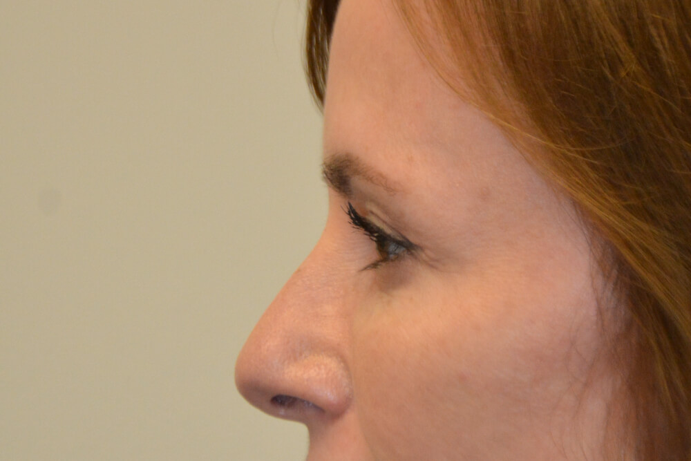 Eyelid-Surgery-11 | After Eyelid Surgery 5