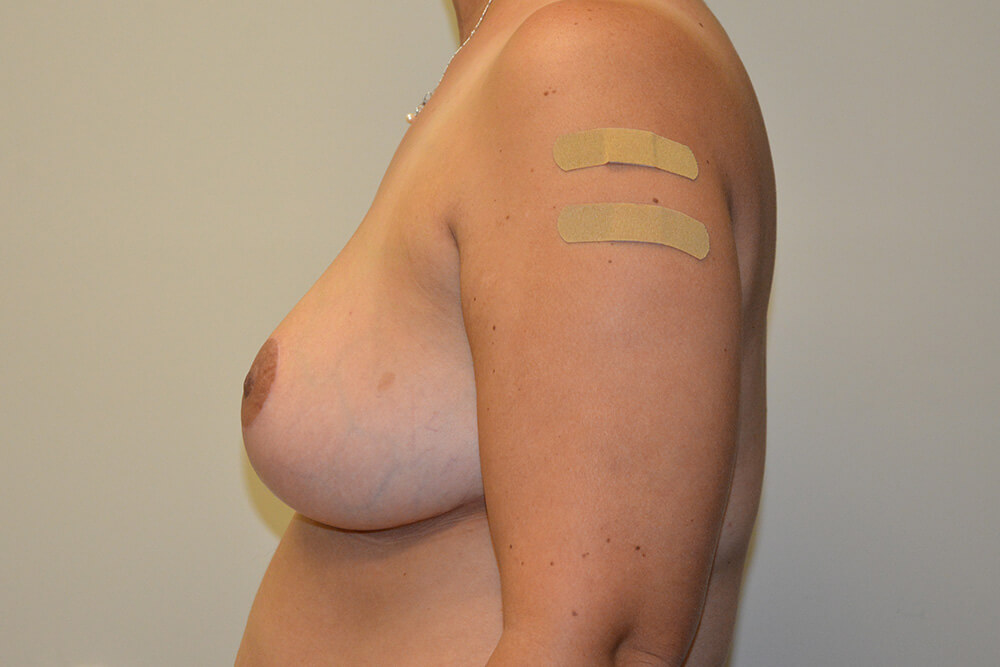 Breast-Reduction-11 | After Breast Reduction 5