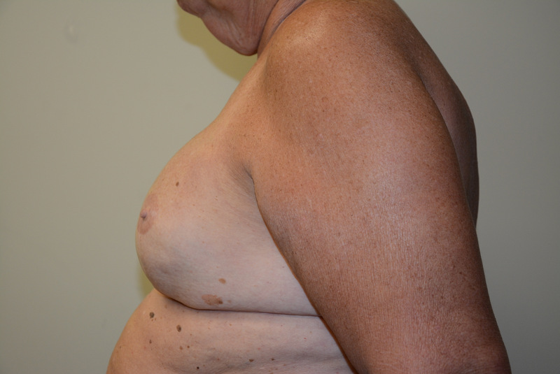 Breast-Reconstruction-Tissue-Expander-11 | After Breast Reconstruction Tissue Expanders 5