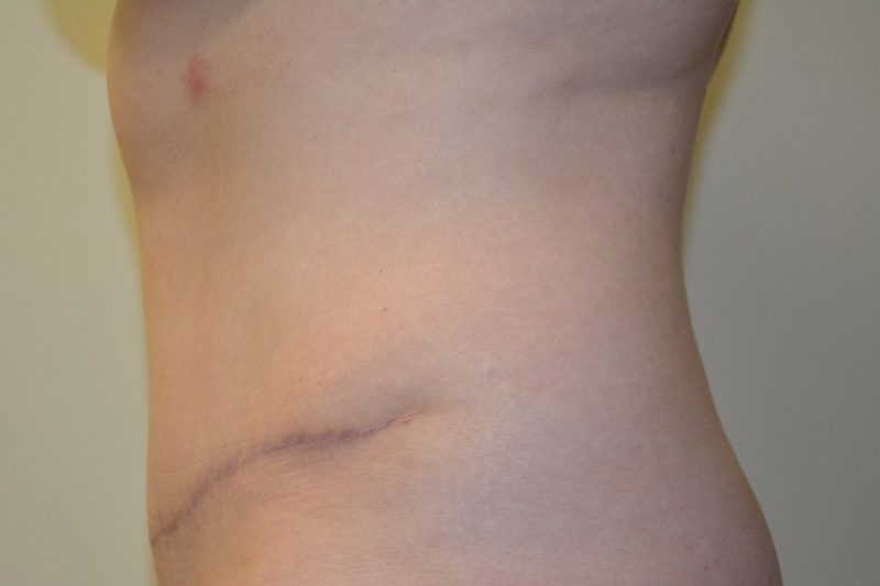 Tummy-Tuck-14 | After Tummy Tuck 5