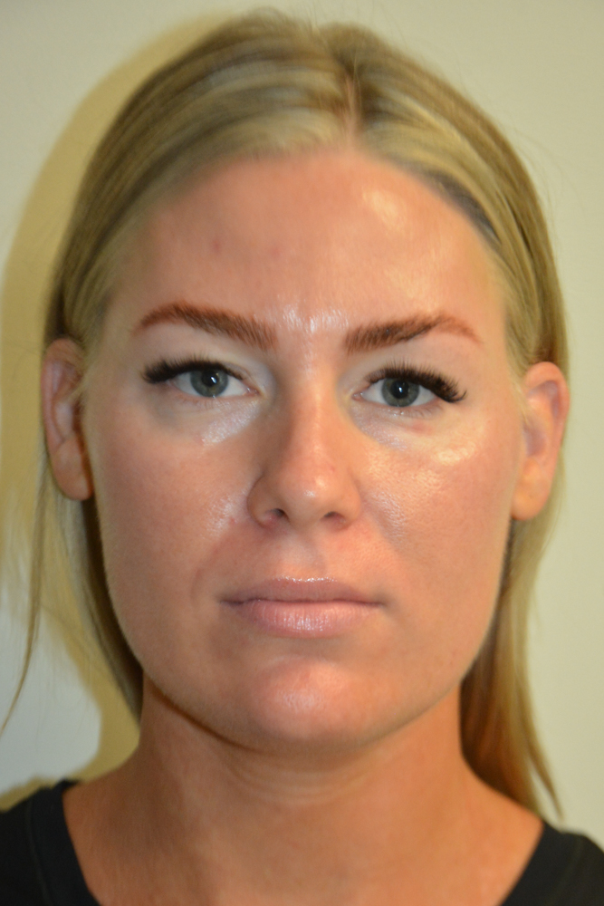 Liposuction-12 | Before Liposuction